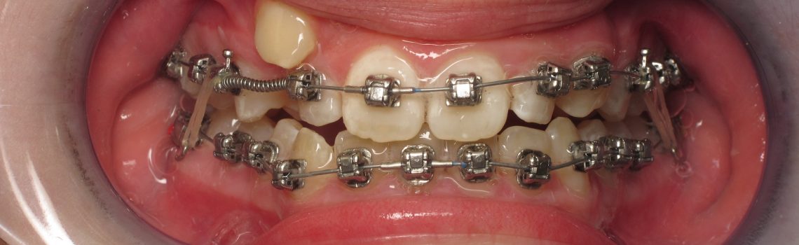 Élastiques en orthodontie Lessines - Cabinet spécialisé en orthodontie